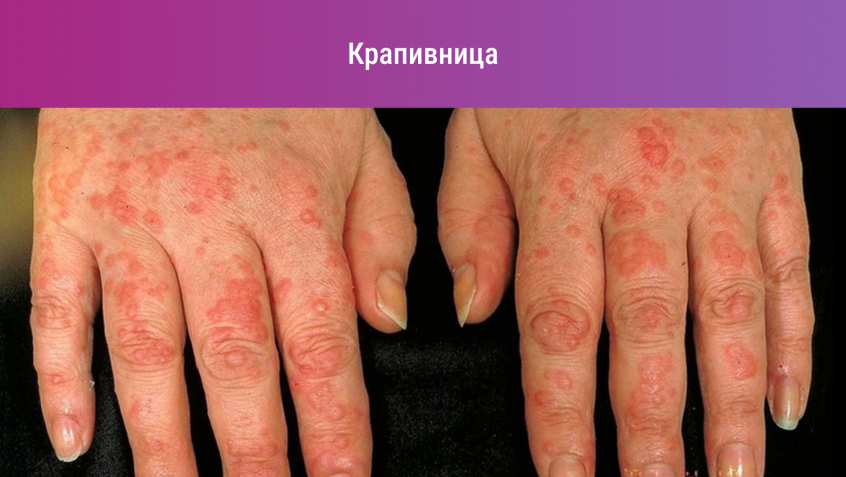 От чего аллергия на руках