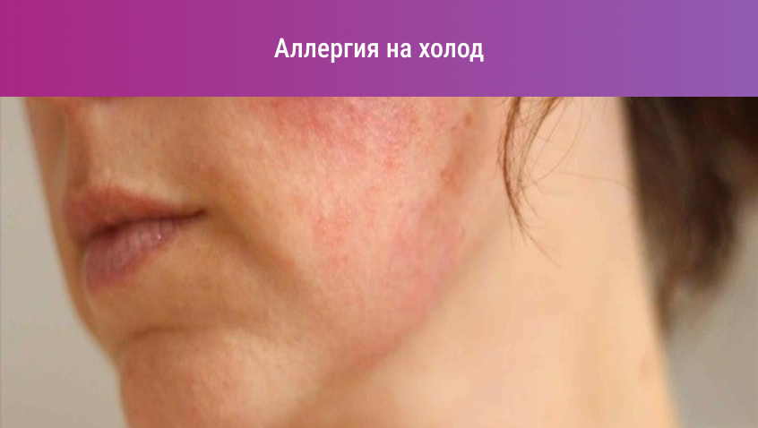 Аллергия на лице: всё о причинах и лечении