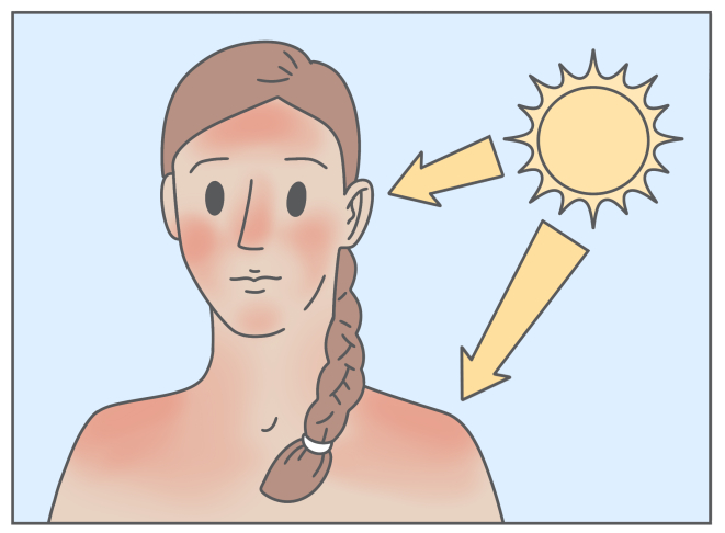 аллергия на солнце