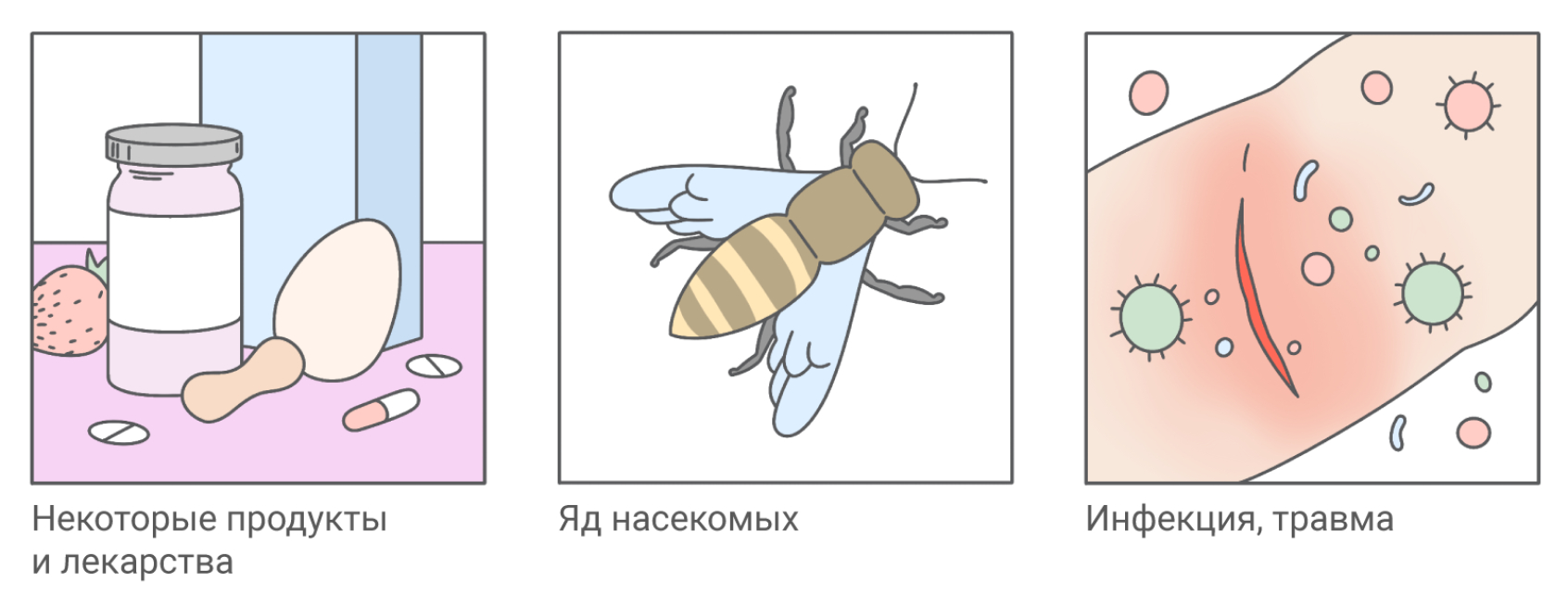 Отёк Квинке (ангионевротический): симптомы, помощь