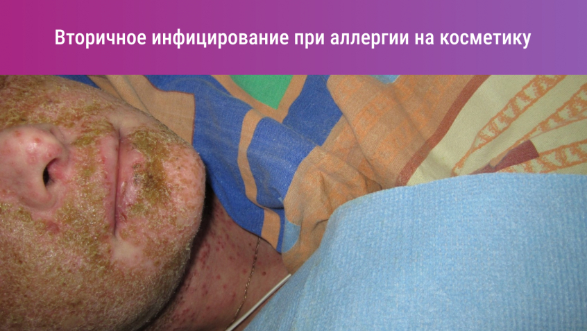 Вторичное инфицирование при аллергии на косметику