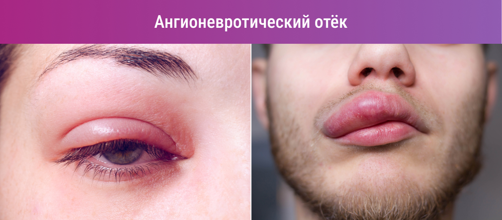 Отёк Квинке (ангионевротический): симптомы, помощь