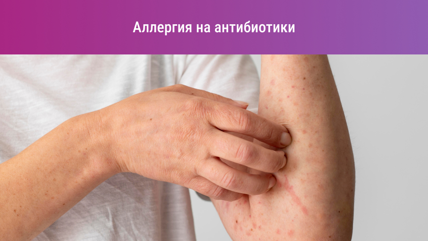 Аллергия после антибиотиков: причины появления