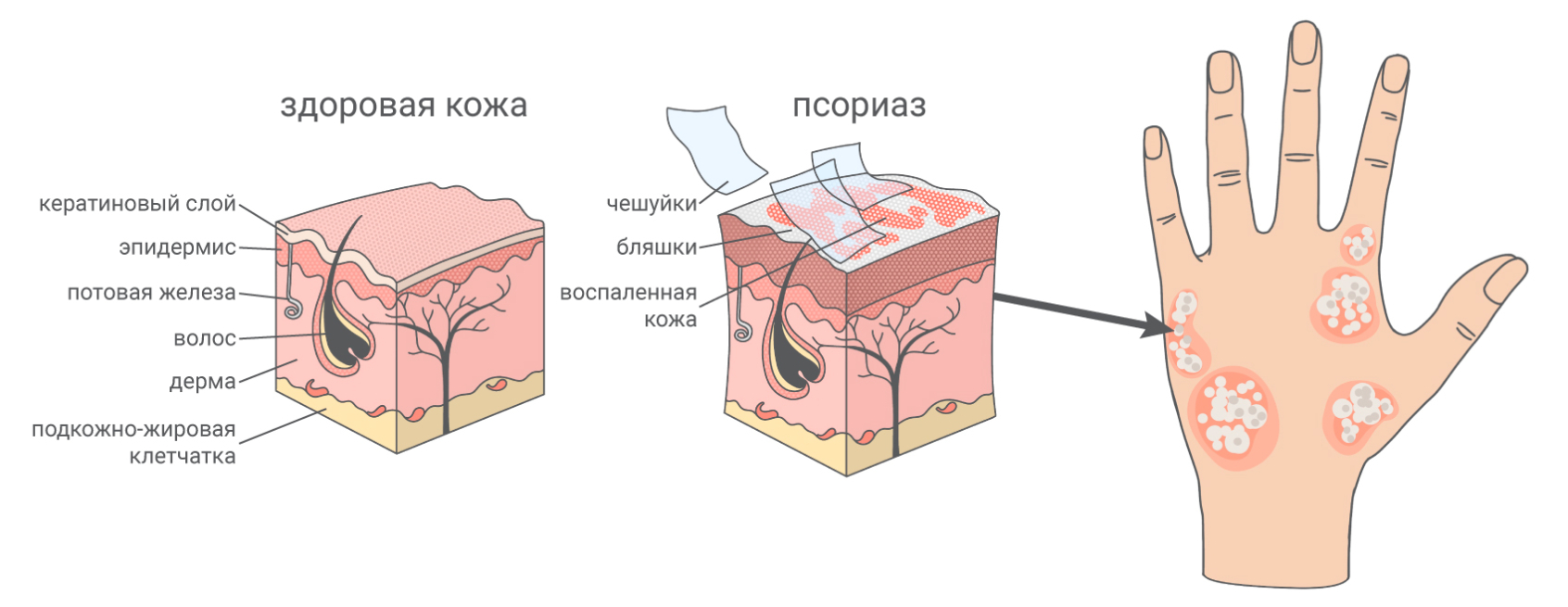 Псориаз: всё о лечении, мазях и препаратах